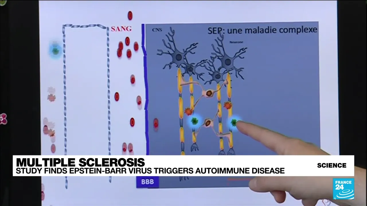 Myelin destruction diagram